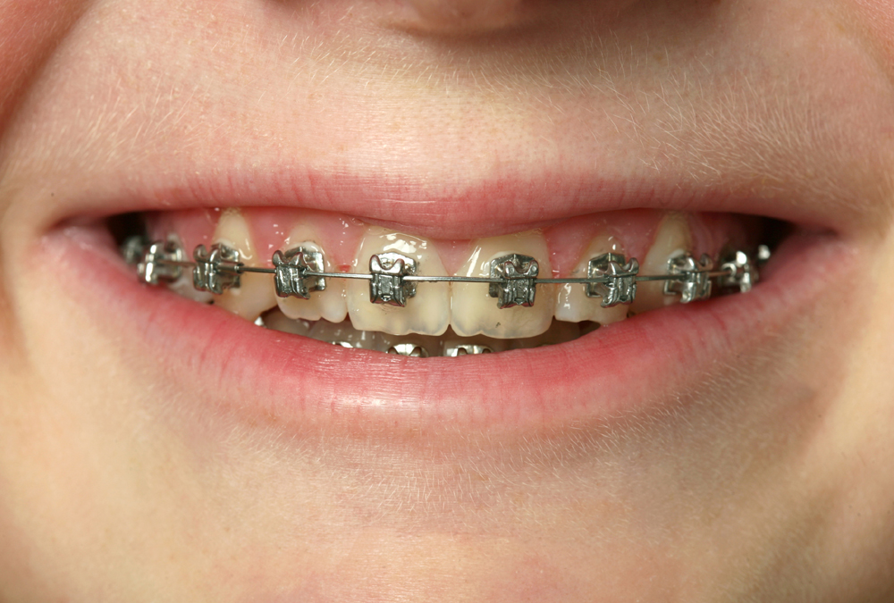 Patient Stuck In Braces For 11 Years, Sues Orthodontist Redorbit
