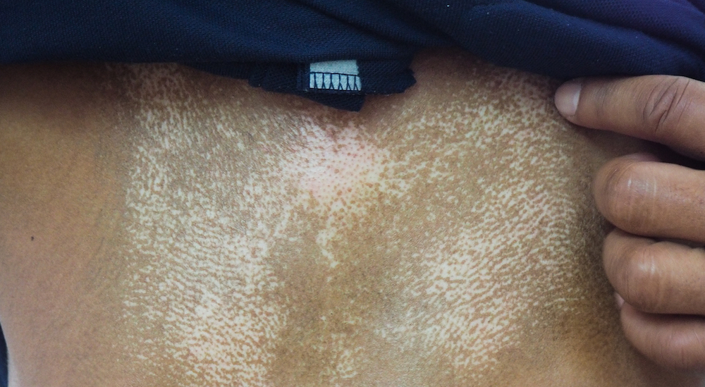 scleroderma symptoms