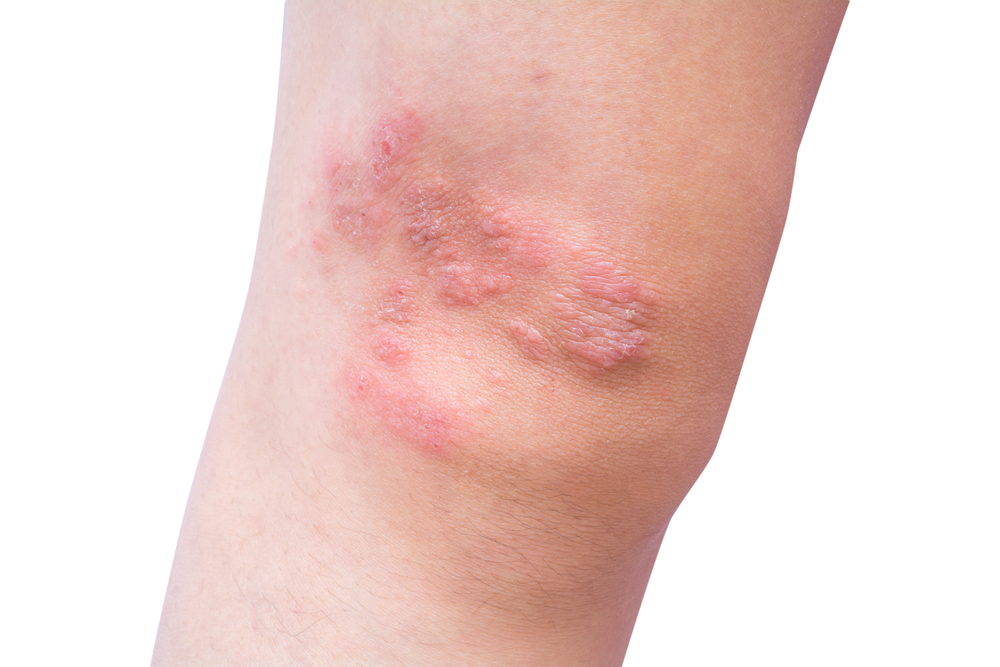 What Causes Dermatitis Herpetiformis? Redorbit